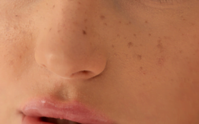 Discover the Art of Beauty Marks and Freckles: Adding Unique Flair to Your Look